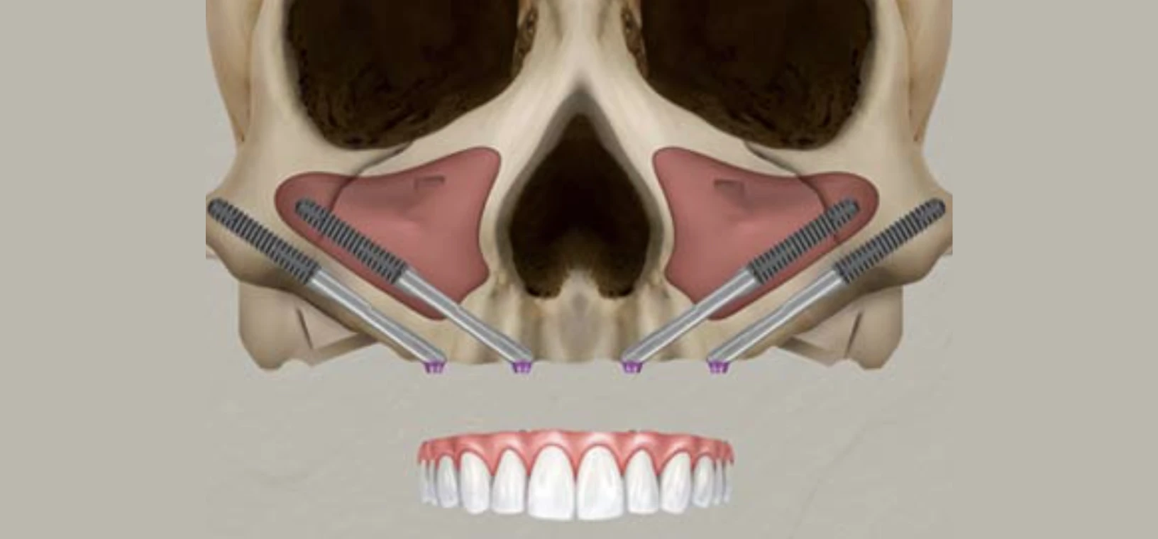 Réhabilitation fixe sur 4 implants zygomatiques au Centre Ruthénois : Quad zygomatique