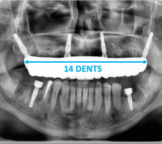 Implant Ptérygoïdien