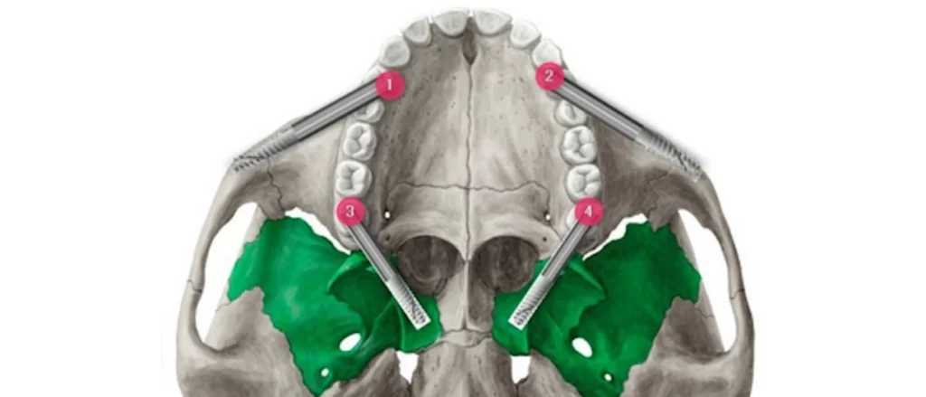 Implant Ptérygoïdien
